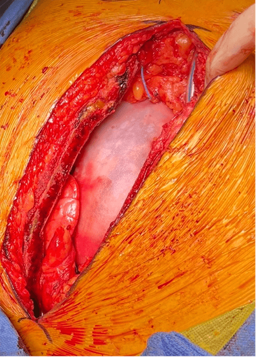 hsfeditor's tweet photo. 🫀The latest work from @PCOMeducation by first author Dr. @mdbiomedical24 and her team is now featured in HSF!

Link👉: https://t.co/HhLm0Radp7

💡Could #CardiaMend #Amiodarone prevent #POAF in #CABG #CardiacSurgery? #PericardialReconstruction #Cardiology
#Surgery #HeartHealth https://t.co/qO7bVLi0B8