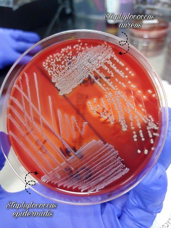 kmlaboratorio's tweet photo. #KMLaboratorio_PatologiaClinica 
Agar sangre:
S. aureus → colonias doradas con β-hemólisis.
S. epidermidis → colonias blancas/grisáceas sin hemólisis.
👉 Diferencia clave: S. aureus hemolítico y patógeno; S. epidermidis no hemolítico y flora normal de piel. 🧪🦠 https://t.co/vsHHsQICgR