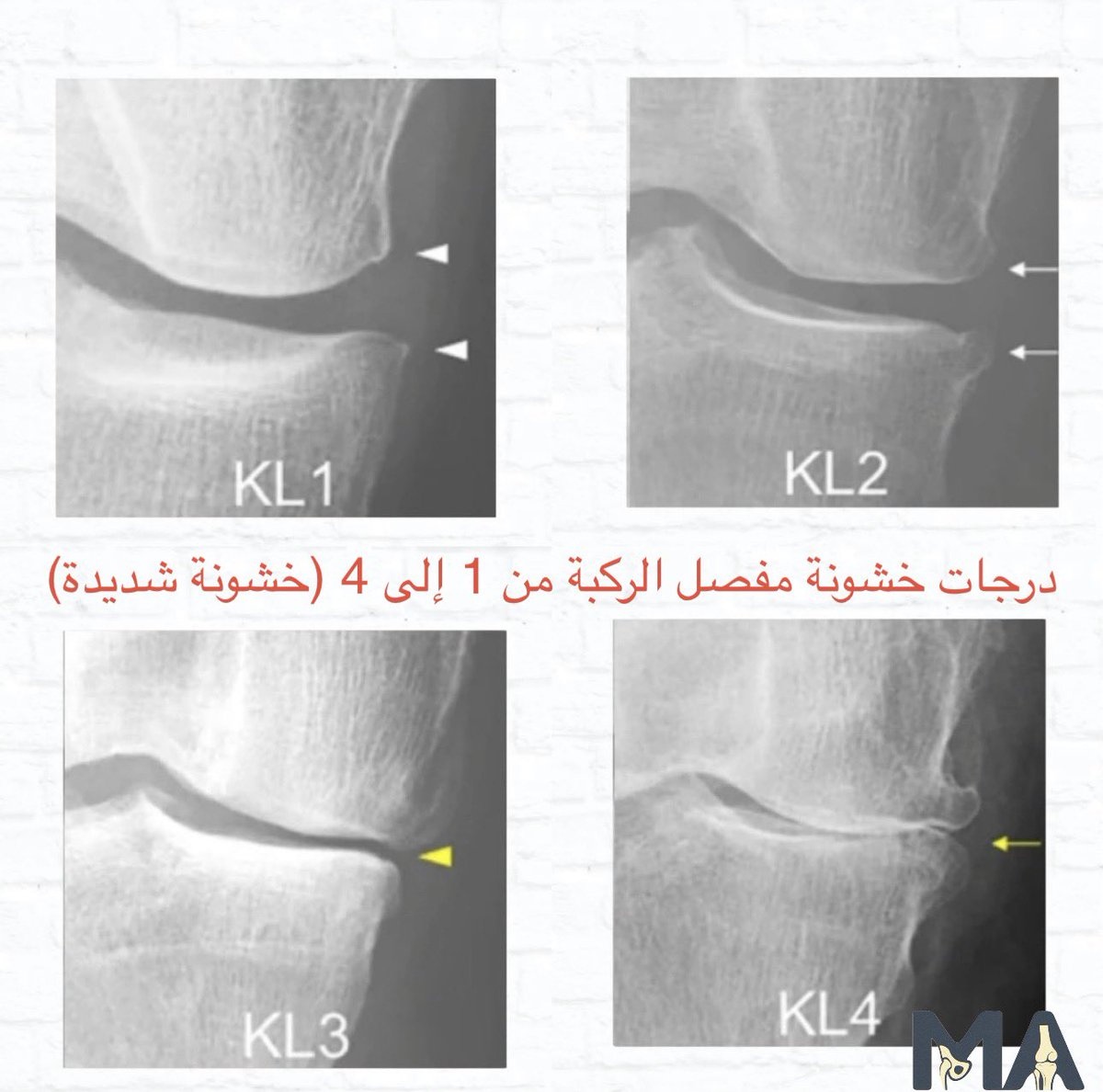 mabushal's tweet photo. #خشونة_الركبة https://t.co/IgfpVHvRv2