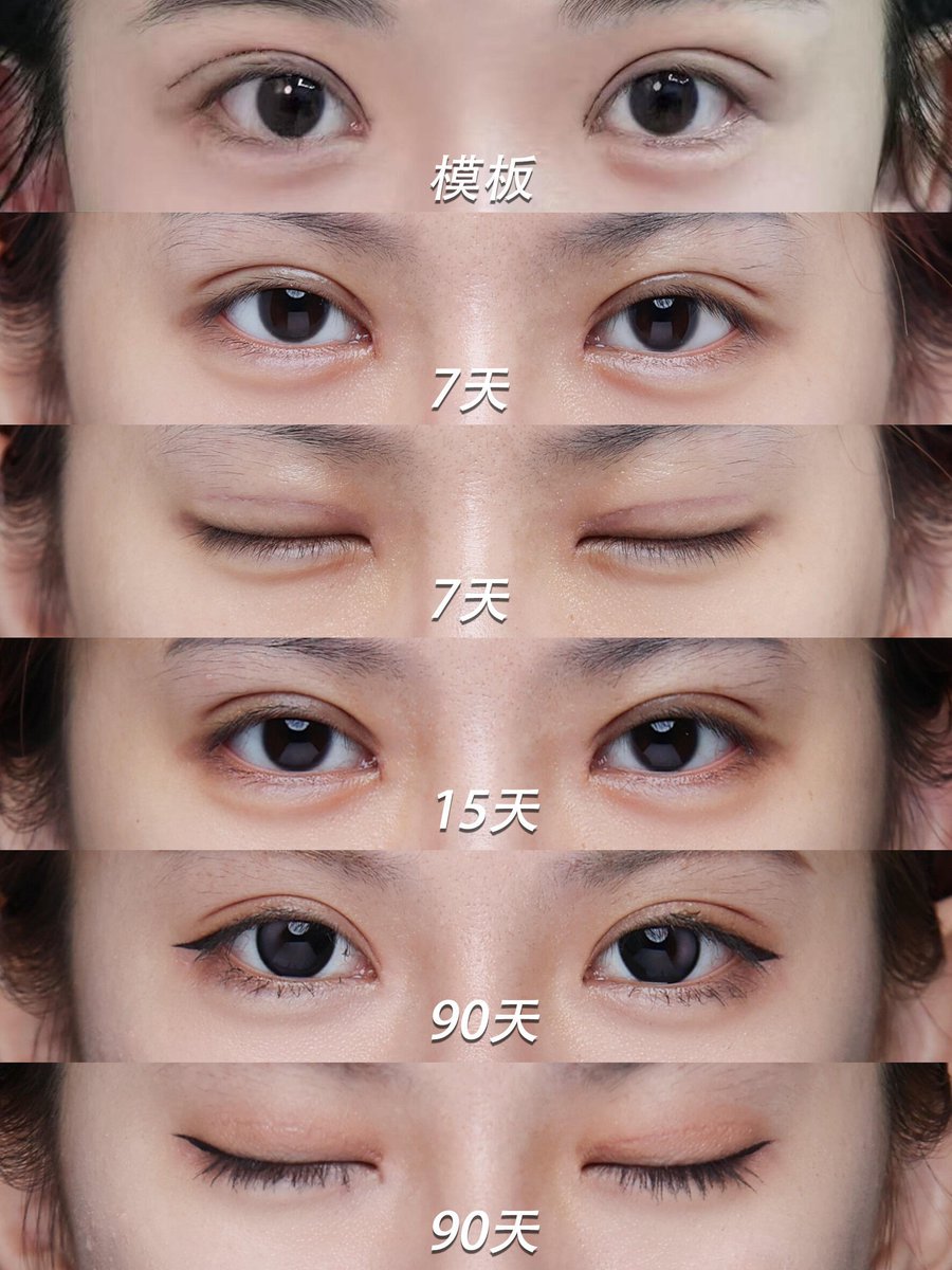 DrLeoSurgery's tweet photo. 如果你也在考虑做双眼皮
但担心恢复期、担心不自然
建议一定要先做好 专业设计
眼睛是面部最精细的结构之一。
设计对了，
美就会慢慢长出来。 https://t.co/Qek11weZOf