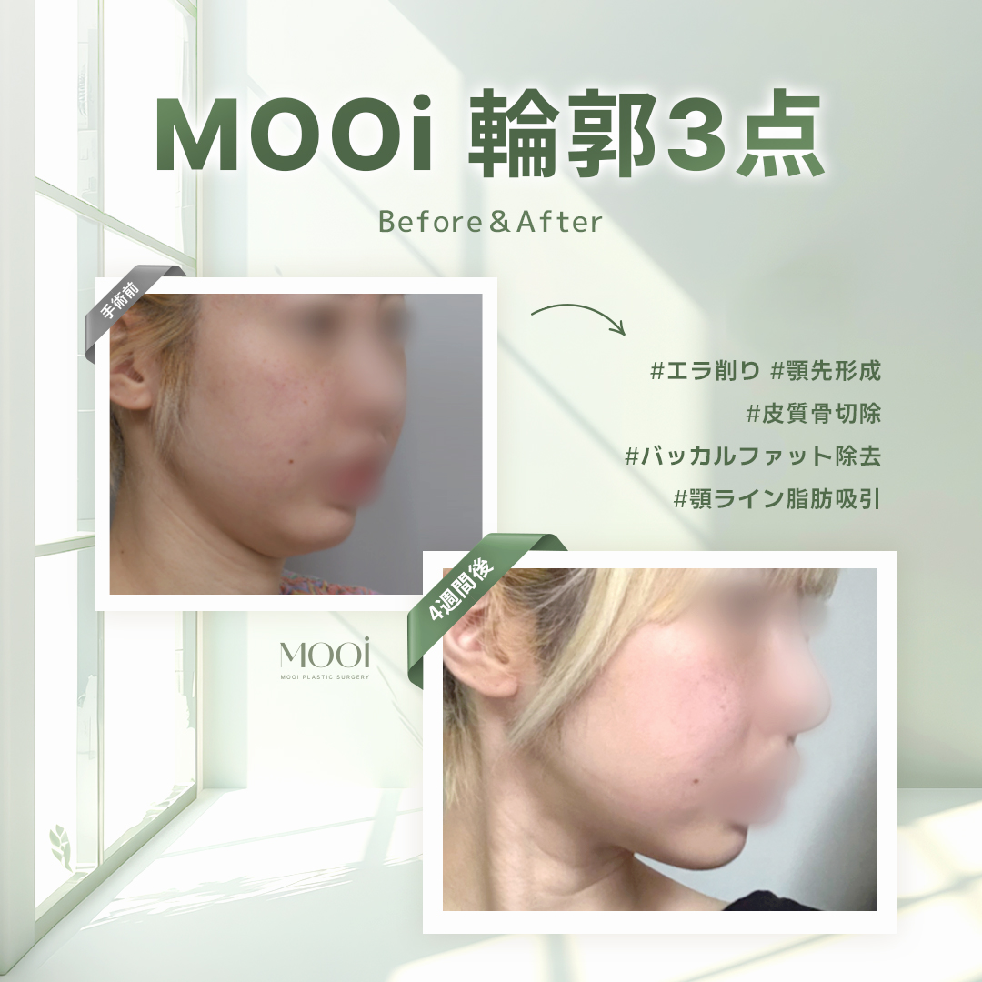 MOOi (ムイ) 整形外科 tweet media