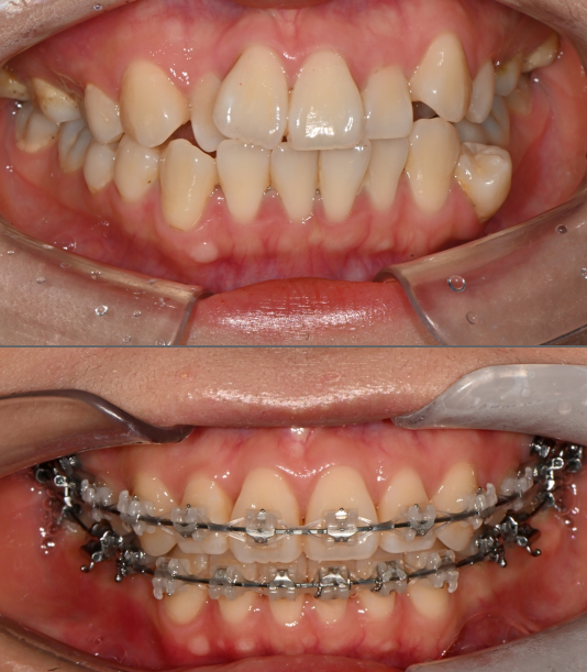 【公式】ル歯科 カンナム歯医者(le:dental clinic) tweet media
