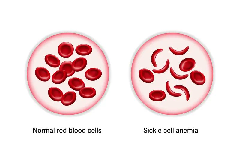 drabdulhameed07's tweet photo. Which drug is used to treat sickle cell anemia?

A. Hydroxyurea
B. Warfarin
C. Aspirin
D. Clopidogrel https://t.co/wmKXI0WAOK