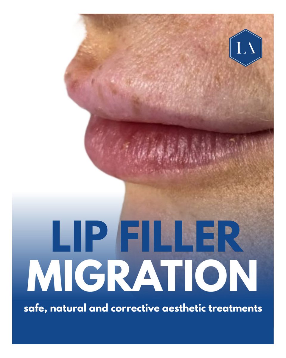 Lip filler migration can happen due to overfilling, product build-up, poor placement, unsuitable product choice or incorrect technique. Choosing the right practitioner matters. At Luxton Aesthetics we prioritise safe, natural results. #naturaliskey #luxtonaesthetics 💫
