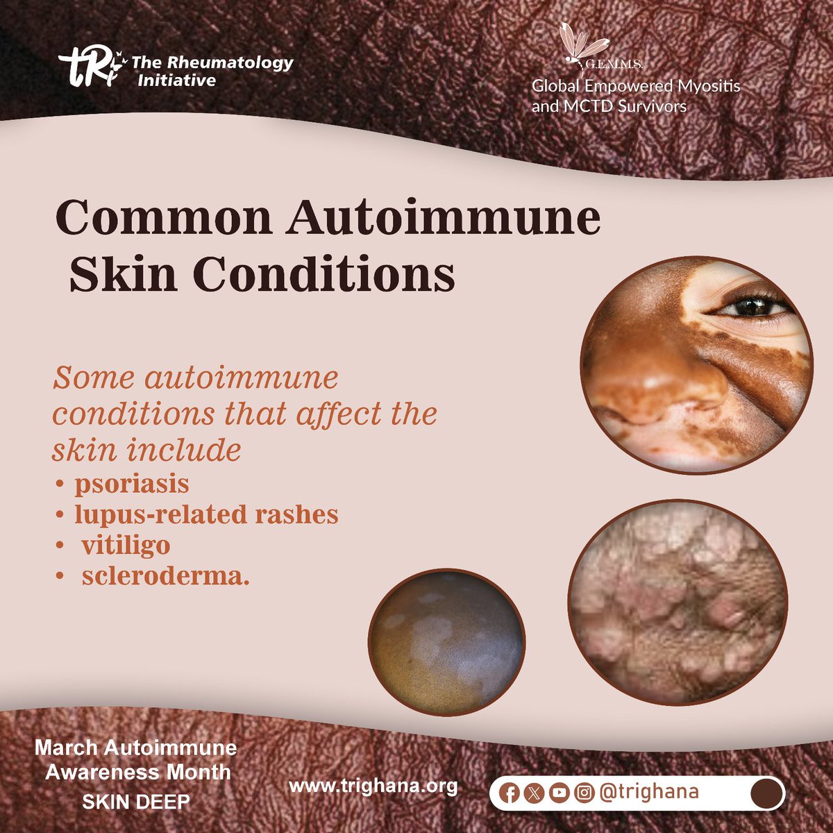 trighana's tweet photo. What are some common autoimmune skin conditions?
 #SkinandAutoimmunedisaease
#Shiningthroughthebumps&amp;scars
#Skindeep
#tRi
#GEMMS
#Psoriasis #vitiligo #scleroderma https://t.co/77OqNGjQ0N