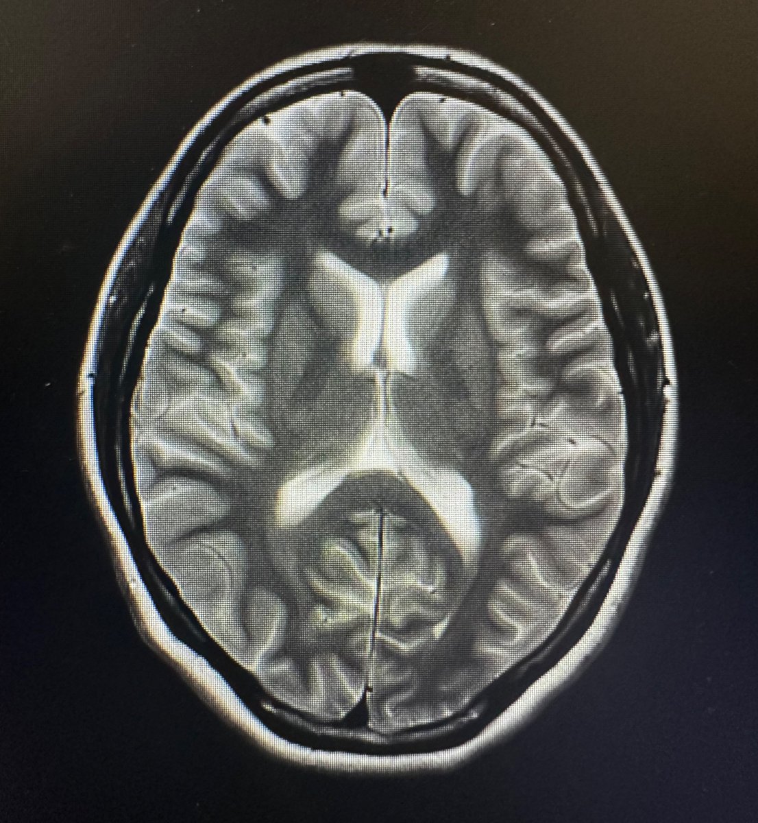 LuaVLucky's tweet photo. Had my brain MRI’d again today!! After I talk to the doc,
Brain evaluation stream 2.0 coming, MRIs are ten years apart https://t.co/eFDcIzbcPy