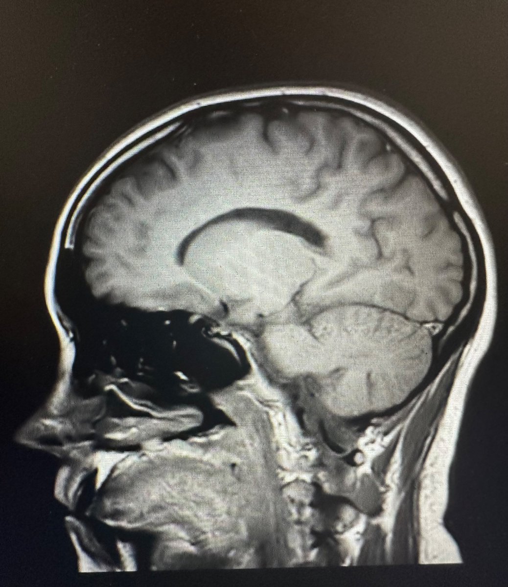 LuaVLucky's tweet photo. Had my brain MRI’d again today!! After I talk to the doc,
Brain evaluation stream 2.0 coming, MRIs are ten years apart https://t.co/eFDcIzbcPy