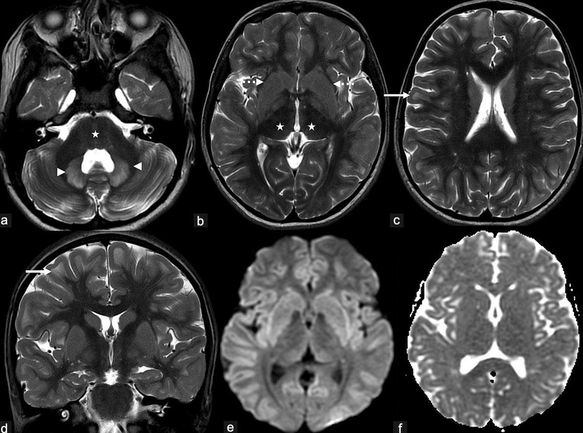 Annals of Indian Academy of Neurology tweet media
