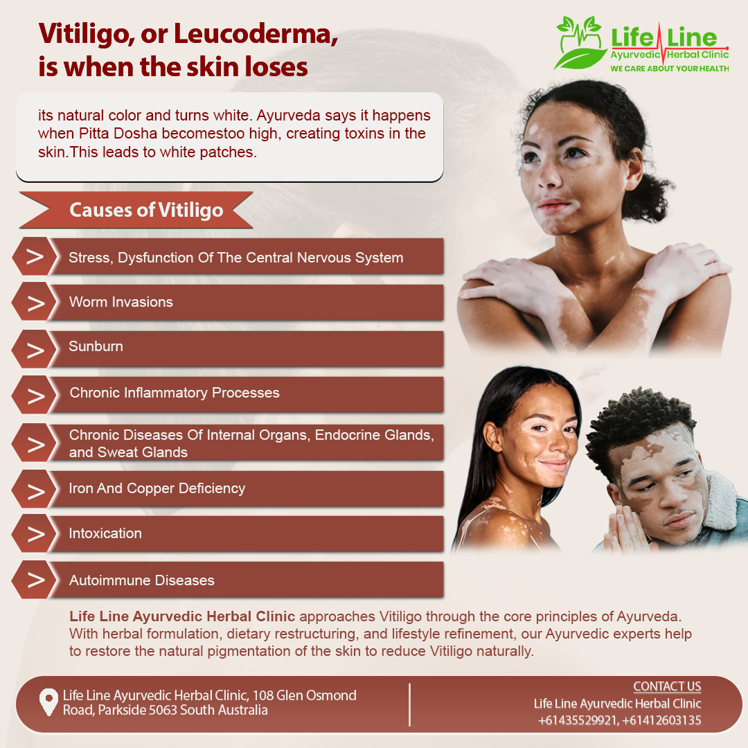 line_clinic's tweet image. Vitiligo, also known as Leucoderma, is a condition where patches of skin lose their natural pigment and turn white. 
🌐For More Details: tinyurl.com/yh8m36r4

#vitiligo #leucoderma #ayurveda #ayurvedic #treatment #whitepatch #skin #whitespot #skincolour