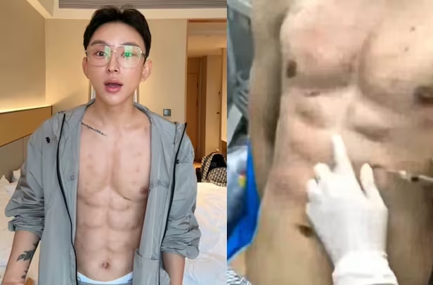 Kyeunsz's tweet photo. 🔥🇨🇳 This Chinese influencer creates artificial abs using hyaluronic acid https://t.co/8T61KQwZWP