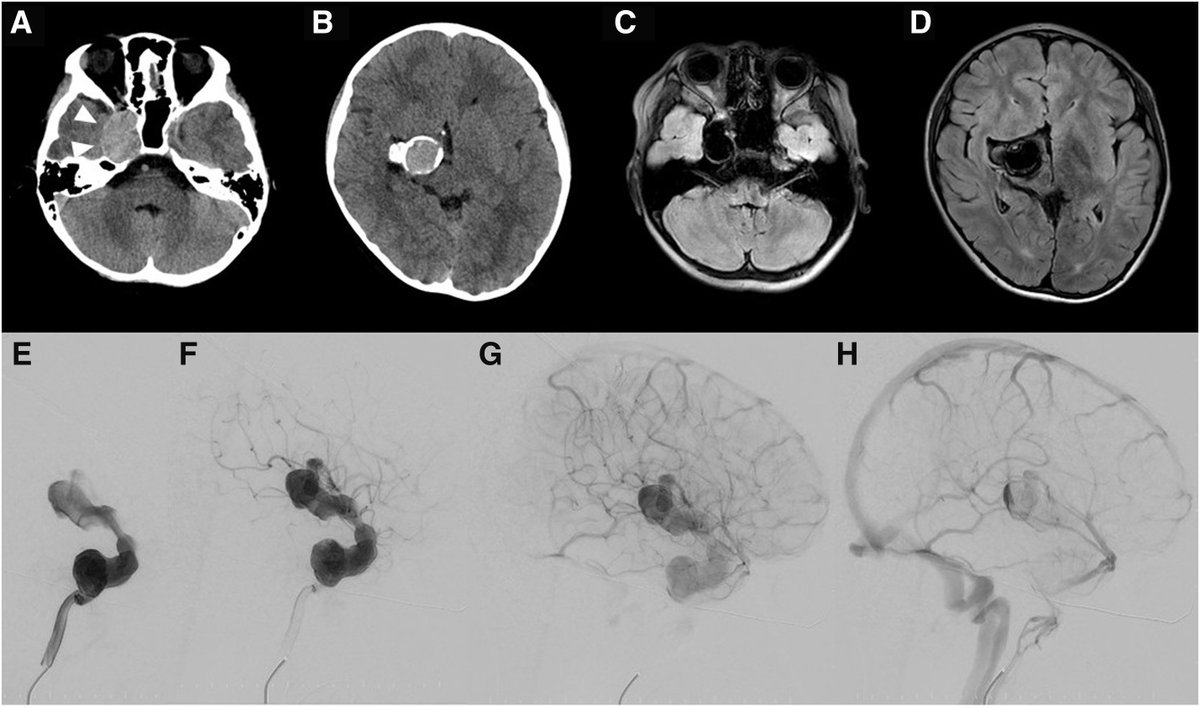 JNET(Journal of Neuroendovascular Therapy) tweet media