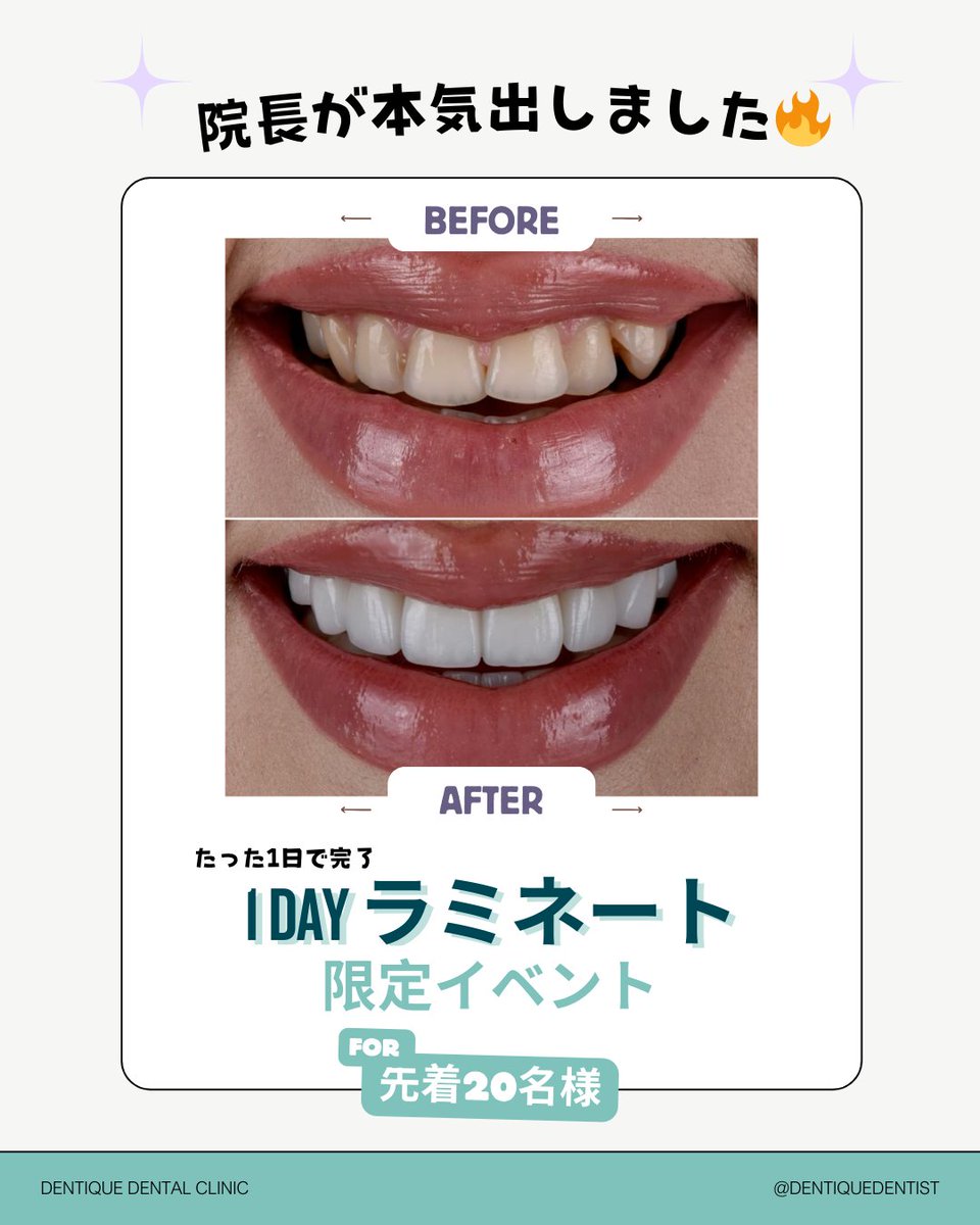 dentiquedentist's tweet photo. 🔥院長が本気出しました🔥

【1DAYラミネート限定イベント】

歯の色・形・すき間を
たった1日で美しいスマイルへ🦷
640,000₩ → 490,000₩/本

☑ 先着20名
☑ 最低6本施術
☑ SNSレビュー条件

口元で笑顔の印象も一気に変わります☺
気になる方はお早めに！

公式ライン➡ https://t.co/TLuByWix7y https://t.co/thMHcWGxbL
