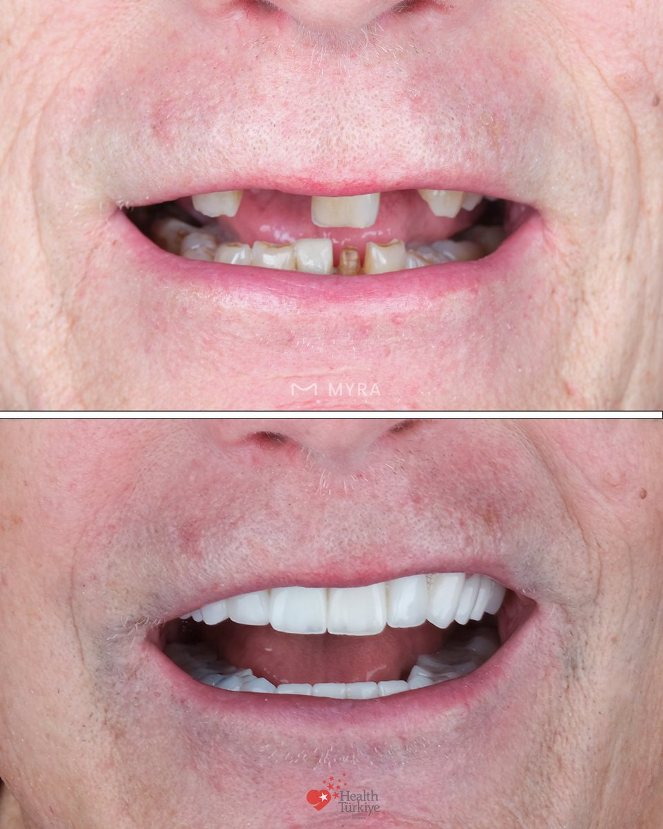 myradental's tweet image. Surgical Phase – USA Patient
5 Extractions
3cc Bone Graft
6 Straumann® Implants
Biological foundation rebuilt.
Implant stability established.
Full mouth rehabilitation in Antalya.
#DentalImplants #Straumann #TeethTurkey