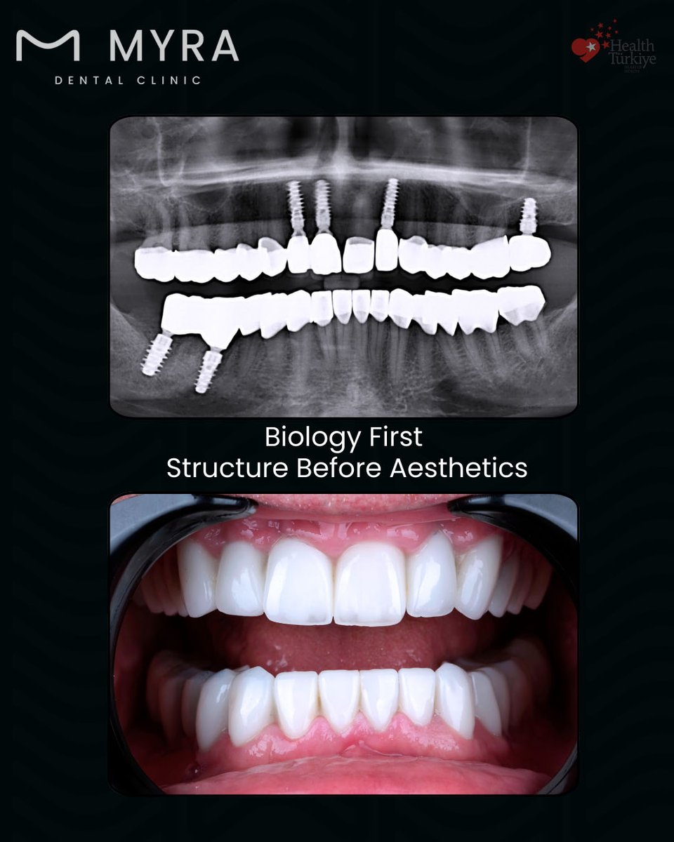 myradental's tweet image. Surgical Phase – USA Patient
5 Extractions
3cc Bone Graft
6 Straumann® Implants
Biological foundation rebuilt.
Implant stability established.
Full mouth rehabilitation in Antalya.
#DentalImplants #Straumann #TeethTurkey