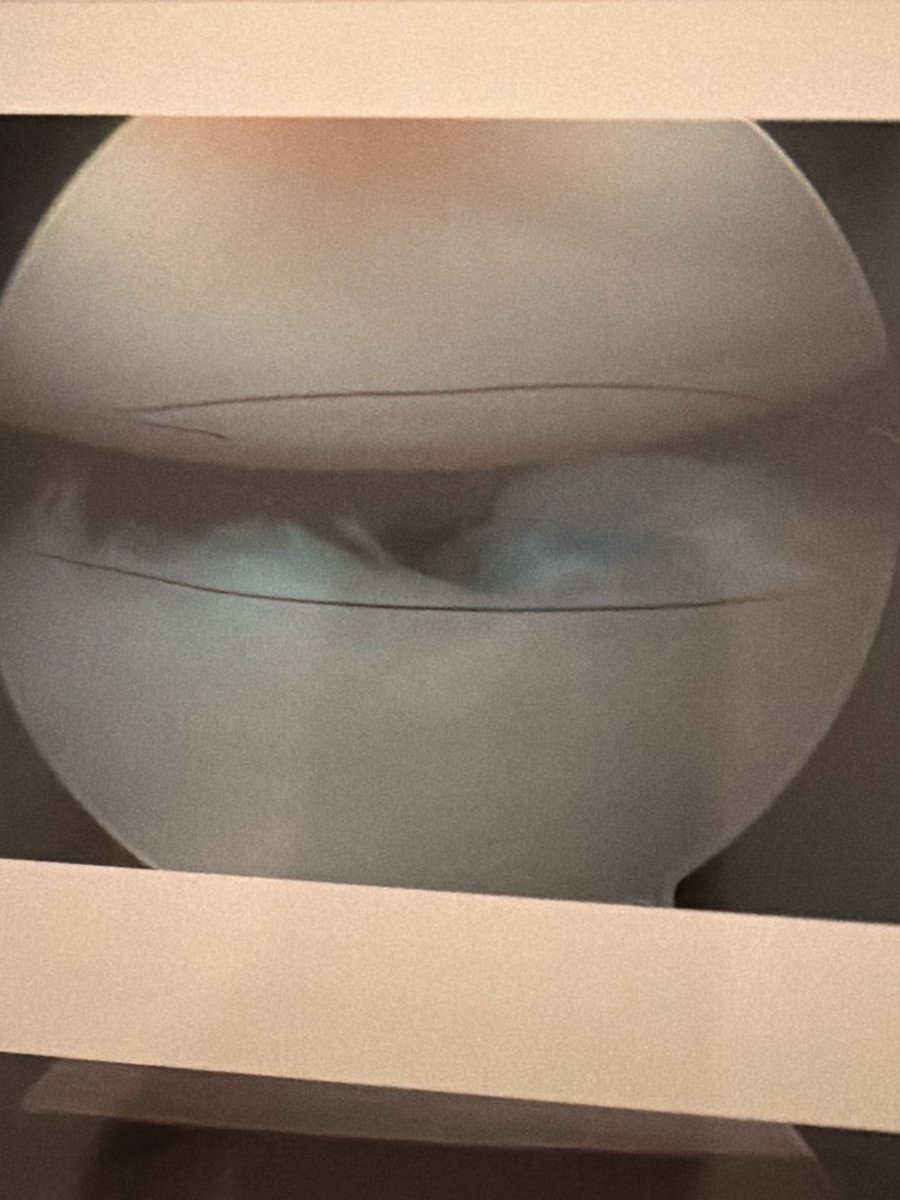 JaydinFrame's tweet photo. I apologize for not posting in a while, I was logged out of my account and also dealing with shoulder surgery to repair my labrum tear. Unfortunately I will have to miss my whole junior season due to recovery, but the surgery was very successful. I’m excited to be back out asap. https://t.co/HXZ39Q25b8