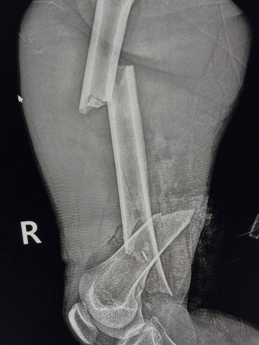 Sage_medics's tweet photo. What is the best surgical procedure to stabilize this patient????? https://t.co/jDUy5flLH2