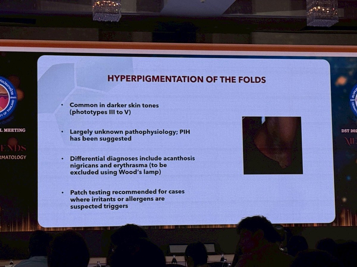 Pop_papp_osk's tweet photo. รอยคล้ำบริเวณรอยพับ (Fold-associated hyperpigmentation) ดูแลยังไง

-พบได้บ่อยในคน ผิวเข้ม (Phototype III–V)
-กลไกยัง ไม่ชัดเจน
-คาดว่าเกี่ยวข้องกับ รอยดำหลังการอักเสบ (PIH) จากการเสียดสี หรือ ระคายเคือง

⭐ ต้องแยกโรคก่อน  คนทั่วไปข้าม
-Acanthosis nigricans (สัมพันธ์ insulin resistance) พวกดื้อน้ำตาล
-Erythrasma (ติดเชื้อแบคทีเรีย)
👉 ใช้ Wood’s lamp ช่วยวินิจฉัย
👉 ถ้าสงสัยแพ้  Patch test

แนวทางรักษา
🧴 ยาทา  ⭐️ไปหาเองว่าตลาดมีครีมทาพวกนี้
-กลุ่ม ลดเม็ดสี  Thiamidol, Niacinamide, Hydroquinone (ใช้สั้น แปปเดียว )
-กลุ่ม เร่งผลัดเซลล์ Retinoids, Glycolic acid, Urea
-Desonide ใช้สั้นเพื่อลด inflammation การอักเสบ

หัตถการ
-Superficial peeling
-Laser (Q-switch Pico )

⭐ สิ่งสำคัญที่สุด = การป้องกัน
✅หลีกเลี่ยง การเสียดสี พวก trauma (wax, ถอน, ขัดแรง)
✅หลีกเลี่ยง สารระคายเคือง