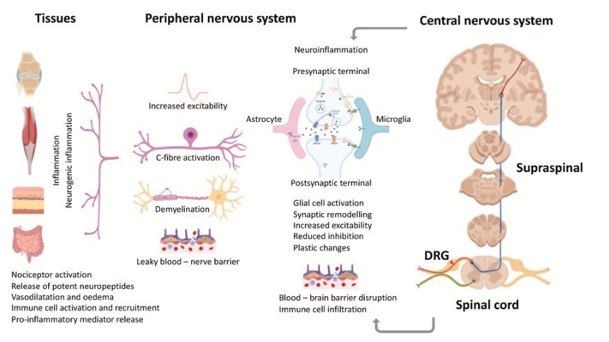 MSKPhysioJnl's tweet image. 📕 #Neuroimmune Special Issue Series - buff.ly/e3Lhv3Y - What are the key neuroimmune processes shaping pain and repair at the tissue, peripheral, and central nervous system levels? #ChronicPain #NeuroImmunology #PainMechanisms #PersonalisedCare