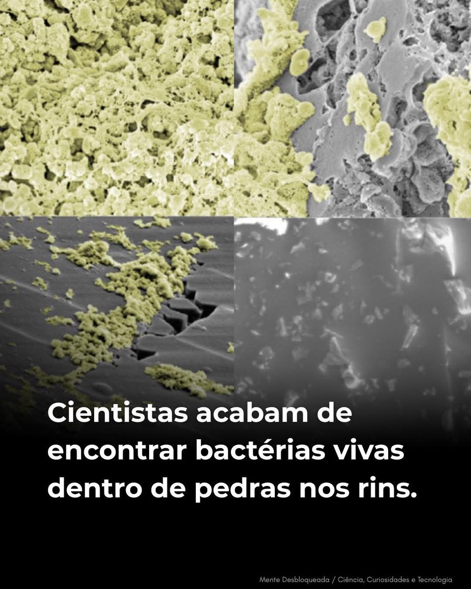 SensoCrtico1's tweet photo. Bactérias vivas dentro de pedras nos rins: uma descoberta que muda tudo

Pesquisadores identificaram bactérias vivas escondidas dentro de pedras de cálcio nos rins, desafiando o entendimento tradicional sobre como esses cristais dolorosos se formam. Antes, os cálculos renais eram vistos apenas como acúmulos minerais decorrentes da urina, mas agora se sabe que microrganismos podem atuar como “sementes”, ajudando na formação das pedras.

O estudo mostrou que essas bactérias ficam protegidas por camadas minerais e biofilmes, o que explica por que algumas pessoas continuam a ter pedras renais crônicas mesmo seguindo dietas rigorosas e tratamentos médicos convencionais. Além disso, os microrganismos podem contribuir para infecções urinárias recorrentes.

Essa descoberta abre novas possibilidades para tratamentos preventivos, focados em interromper a presença das bactérias durante a formação das pedras, oferecendo esperança para milhões de pacientes que sofrem com essa condição dolorosa.

Fonte: Proceedings of the National Academy of Sciences (2026). Intercalated bacterial biofilms are intrinsic internal components of calcium-based kidney stones. PNAS.