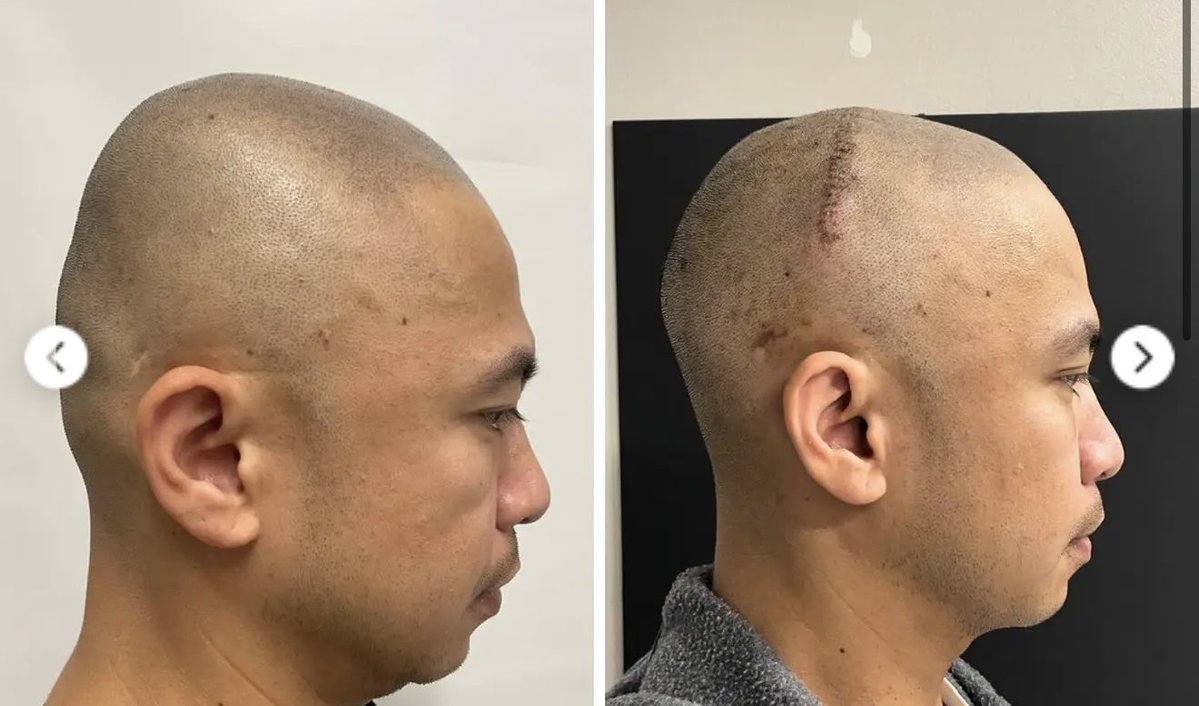 平均6mm削れるらしい。

頭蓋骨削り。クソやりたい、