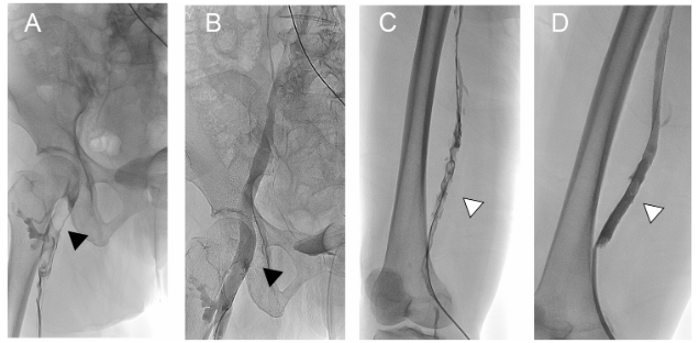 Thrombosis_J's tweet photo. 💡Article Alert 💡
Efficacy, safety, and influencing factors of AngioJet mechanical thrombectomy versus catheter-directed thrombolysis in the treatment of acute lower limb deep vein thrombosis
#OpenAccess #AngioJet #ThrombosisResearch
Read the article: https://t.co/32cijAihkK https://t.co/TbO7xqBA60