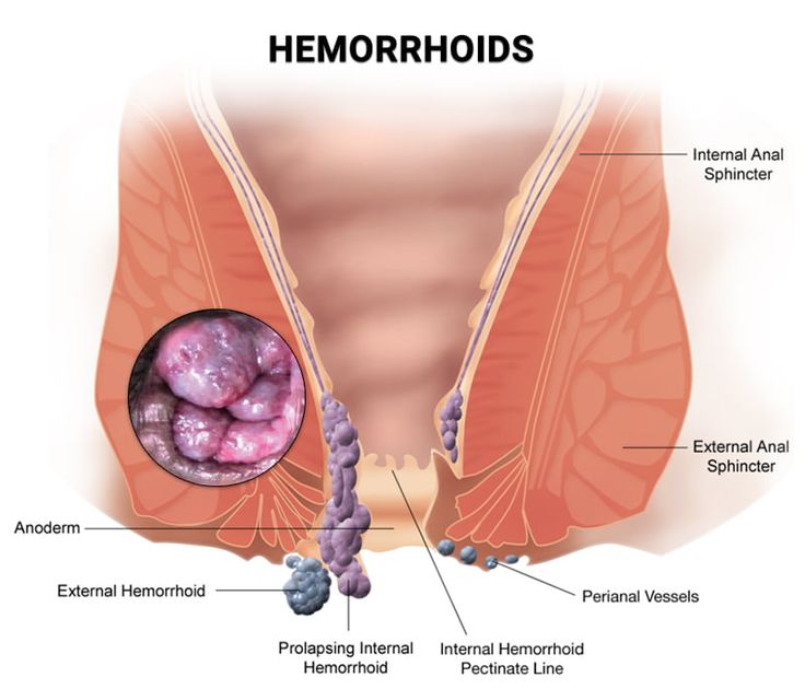 Nig_Farmer's tweet photo. #NaijaFarmerTips

For the last time, pile is not a de@th sentence, so there’s no need to panic about it.

Pile, also known as hemorrhoids, is a painful and uncomfortable condition that can make simple activities like sitting, walking, or even using the toilet very difficult. 

Some people notice stains on their underwear, while others avoid going to the toilet because of the pain, swelling, or discomfort. 

The truth is that it’s a very common condition.
Here’s a simple natural routine that many people use to manage it:

Ingredients:
– 3 pieces of bitter kola
– 3 red onions
– Clean water

Preparation and use:

1) Grind the bitter kola until it becomes a paste.

2) Chop the red onions into small pieces.

3) Put both ingredients into a pot and add about 3 litres of clean water.

4) Boil the mixture on moderate heat for about 30 minutes.

5) Allow it to cool, then drink one small cup twice daily until the mixture is finished.

Share this with someone who you know is currently experiencing this.