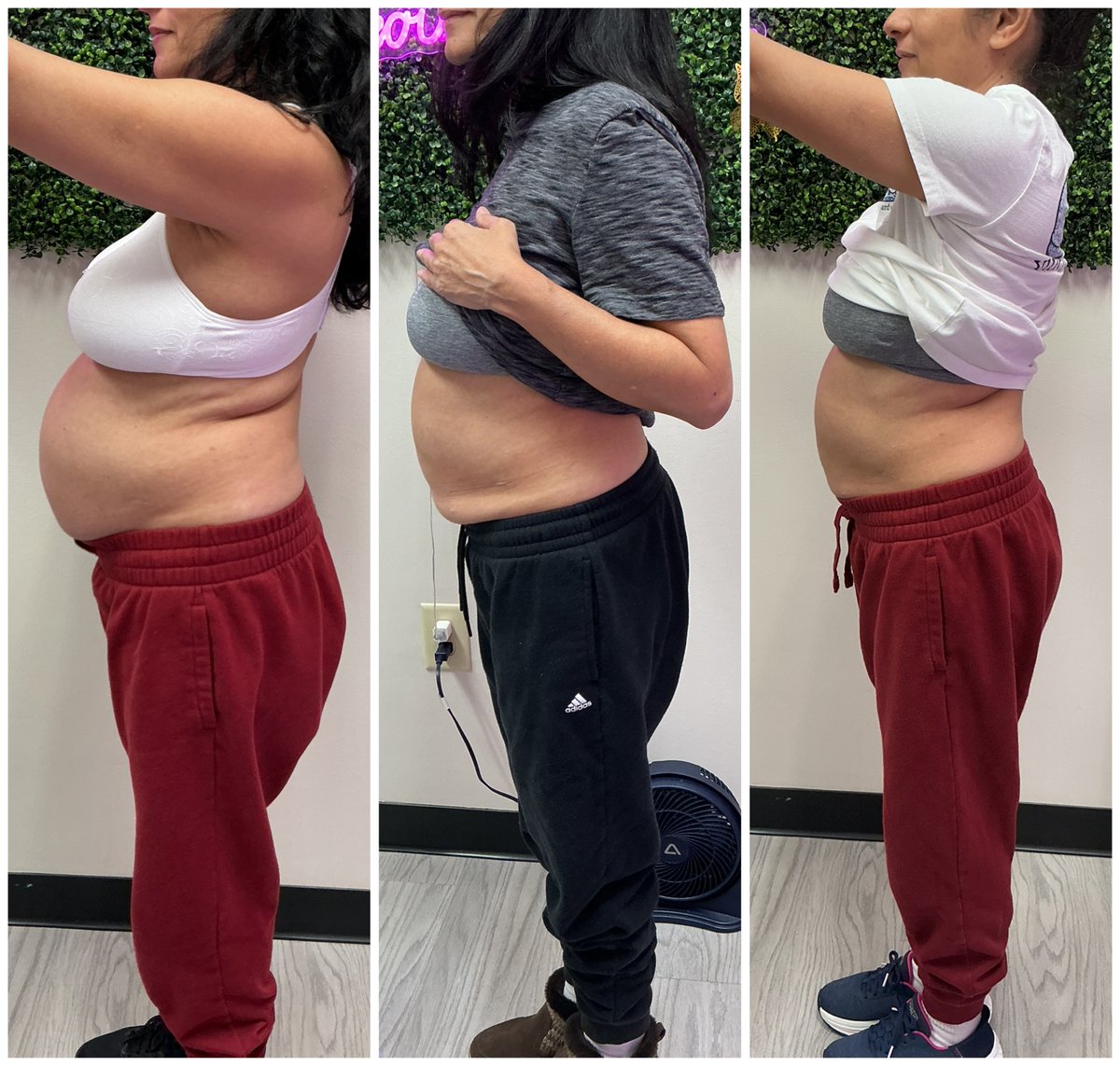 InShapeMDclt's tweet photo. 💭 Stubborn belly fat? Lipo Dissolve works for men &amp; women, targeting stubborn fat pockets. Our patient is on her 3rd session!

✨ Non-surgical ✅ Gradual, natural results ✅ Fat cells permanently destroyed ✅

Start your transformation today! 🔗 https://t.co/wRt9Wr9HD4 https://t.co/xtnTcqoula