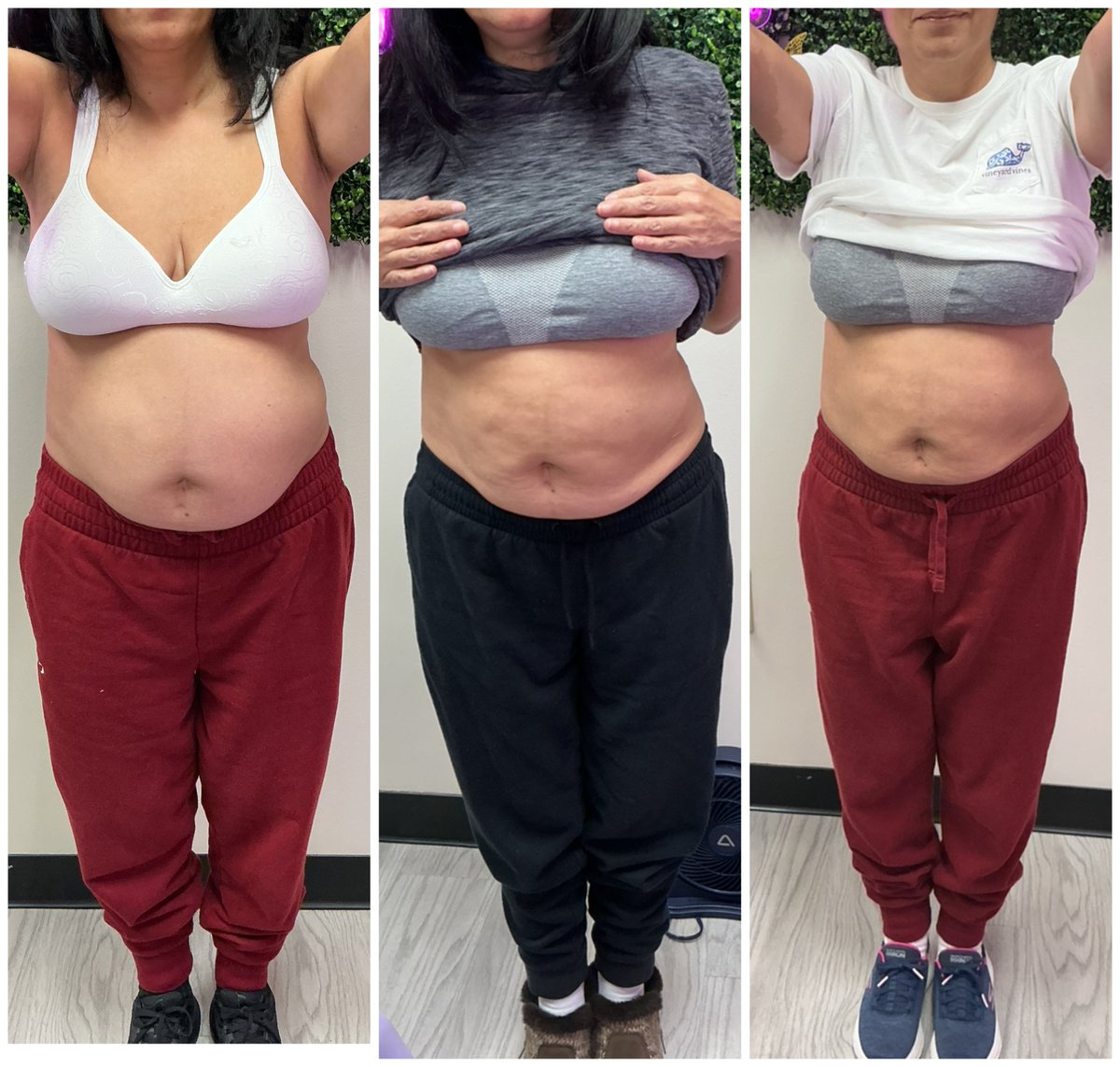 InShapeMDclt's tweet photo. 💭 Stubborn belly fat? Lipo Dissolve works for men &amp; women, targeting stubborn fat pockets. Our patient is on her 3rd session!

✨ Non-surgical ✅ Gradual, natural results ✅ Fat cells permanently destroyed ✅

Start your transformation today! 🔗 https://t.co/wRt9Wr9HD4 https://t.co/xtnTcqoula