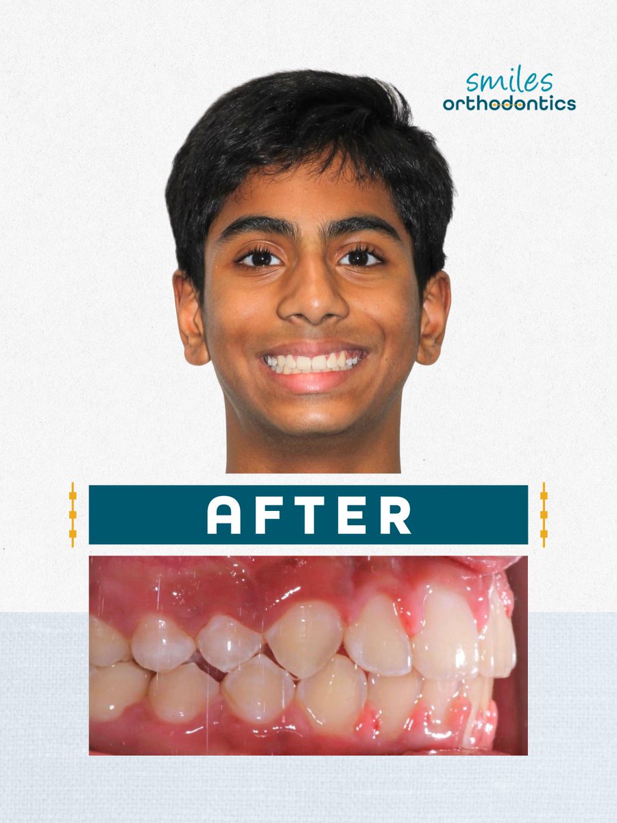 smilesortho's tweet image. We have a very special smile transformation—Dr. G’s son, Srihan! 🦷✨

His braces are off, and we’re so excited to celebrate this milestone and his amazing new smile. Such a special moment in the office! 💙

#BeforeAndAfter #SmileTransformation #Orthodontics #NewSmile