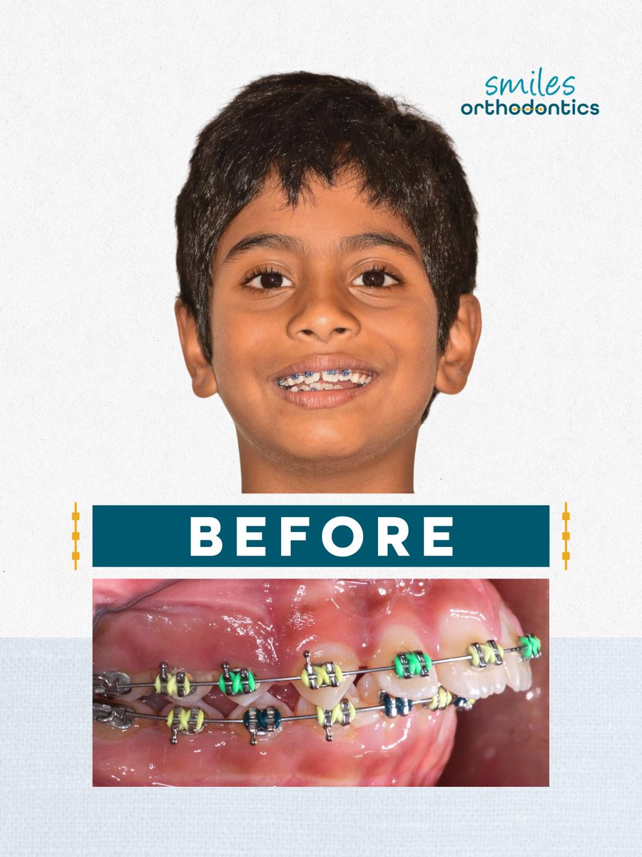 smilesortho's tweet image. We have a very special smile transformation—Dr. G’s son, Srihan! 🦷✨

His braces are off, and we’re so excited to celebrate this milestone and his amazing new smile. Such a special moment in the office! 💙

#BeforeAndAfter #SmileTransformation #Orthodontics #NewSmile