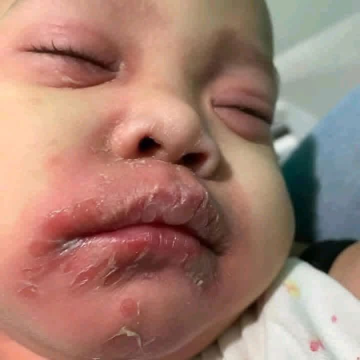 My heart hurts when I see my little sister like this 💔 The skin around her mouth is cracked and peeling, and every time she moves her lips or tries to feed, it seems painful. Sometimes she cries because the area is so sensitive, as if her skin is burning.
Someone who sees the