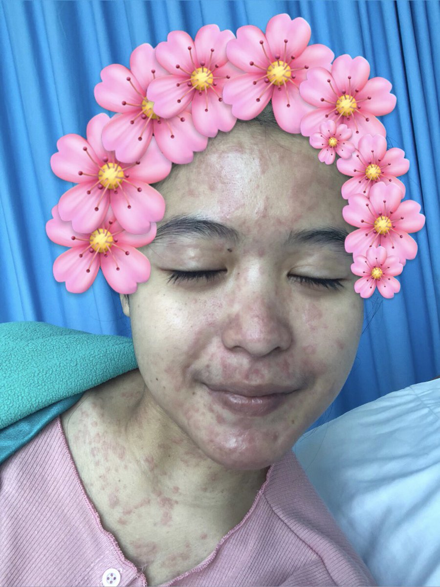 fallinbrunette's tweet photo. Juni tahun lalu. Memang sering keluar masuk RS karena punya riwayat autoimun SLE. After keluar RS, besoknya langsung KKN😭🤘🏻

I hope everyone in the best of health💗🫰🏻 https://t.co/JuUxzTKK9e
