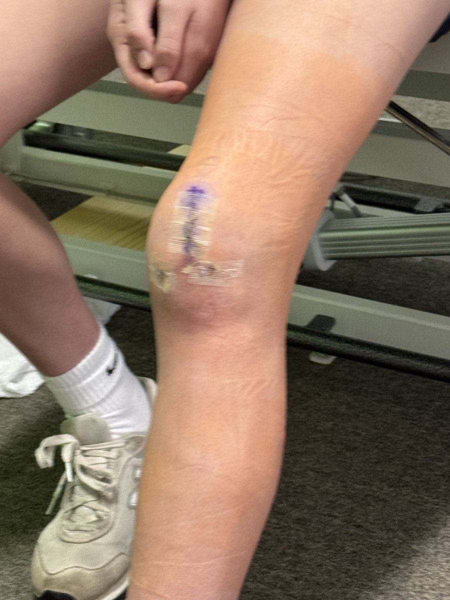 ReeseReinitz29's tweet photo. Since January it’s been all about the grind. Knee surgery, rehab, and getting stronger every single day.
Last week I started running again and I’m back to throwing and hitting. The comeback is in motion.
Can’t wait to be back on the field. 💪🥎  @tnfc2029roberts https://t.co/KT9KiNzvGm