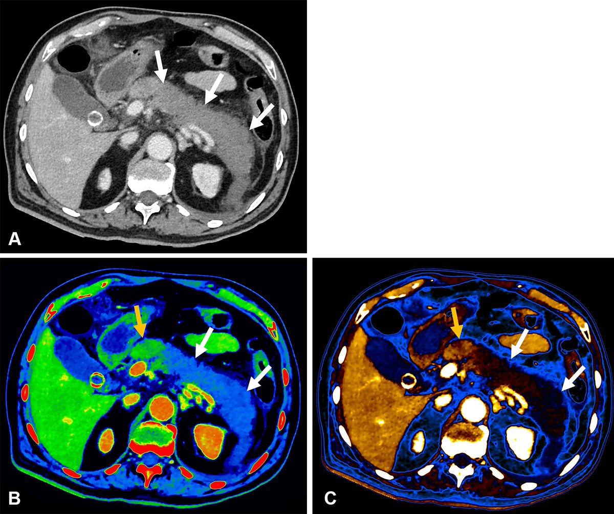 RSNA's tweet photo. Dual-energy CT (DECT) is expanding what’s possible in abdominal imaging.

This RadioGraphics article reviews how quantitative DECT parameters can improve tissue characterization, lesion detection and imaging biomarkers—and where challenges remain for clinical adoption.

Read more: https://t.co/ZExByJQLm2
#DualEnergyCT #AbdominalImaging