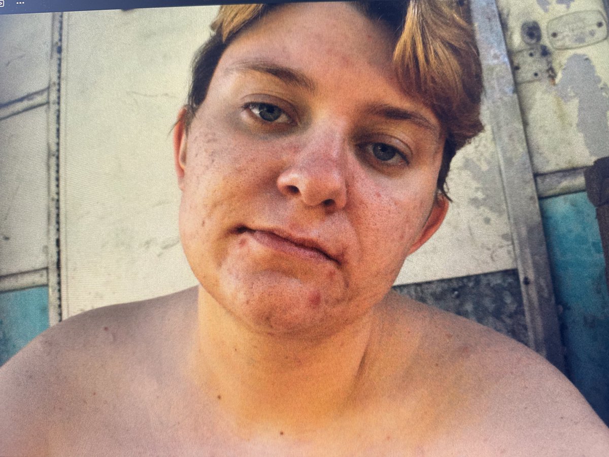 Detransition selfie I took within months of reckoning with my sex. 

I knew it was a hard road to recover from CPTSD caused by mastectomy and living a lie for 4 years. 

I was determined to give myself a chance to live. I made it through. 

Repost for the girls still reckoning.