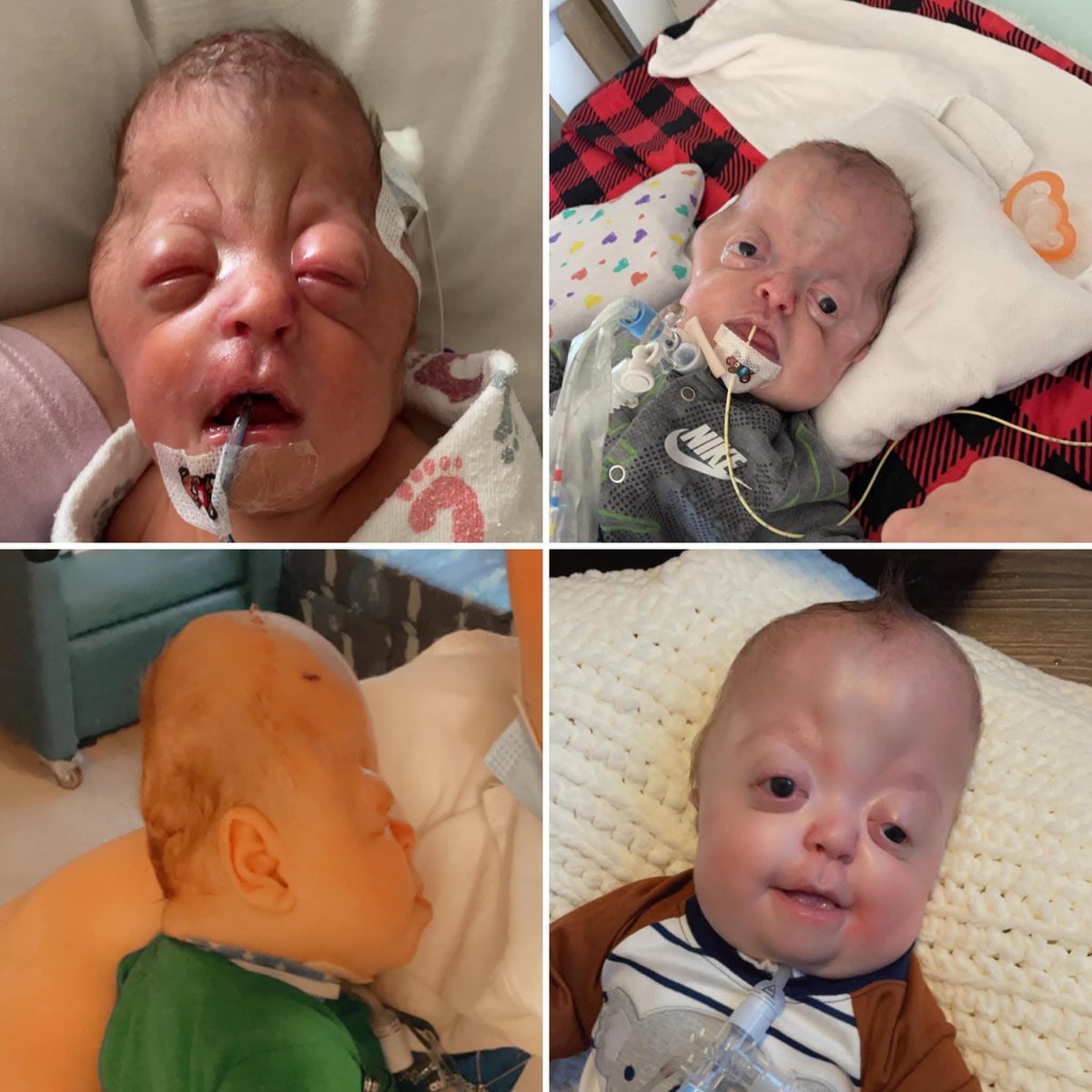 Nooor_Khan021's tweet photo. Before and after surgery  💀 remember Raedyn in your prayers. 🙏 https://t.co/7YeLLDPgws