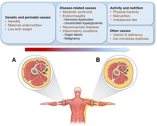 Omid_HopeUni's tweet photo. Sarcopenia in Youth

#muscle #sarcopenia #health
https://t.co/ao7QhMzdyu https://t.co/x6XfpqtykL