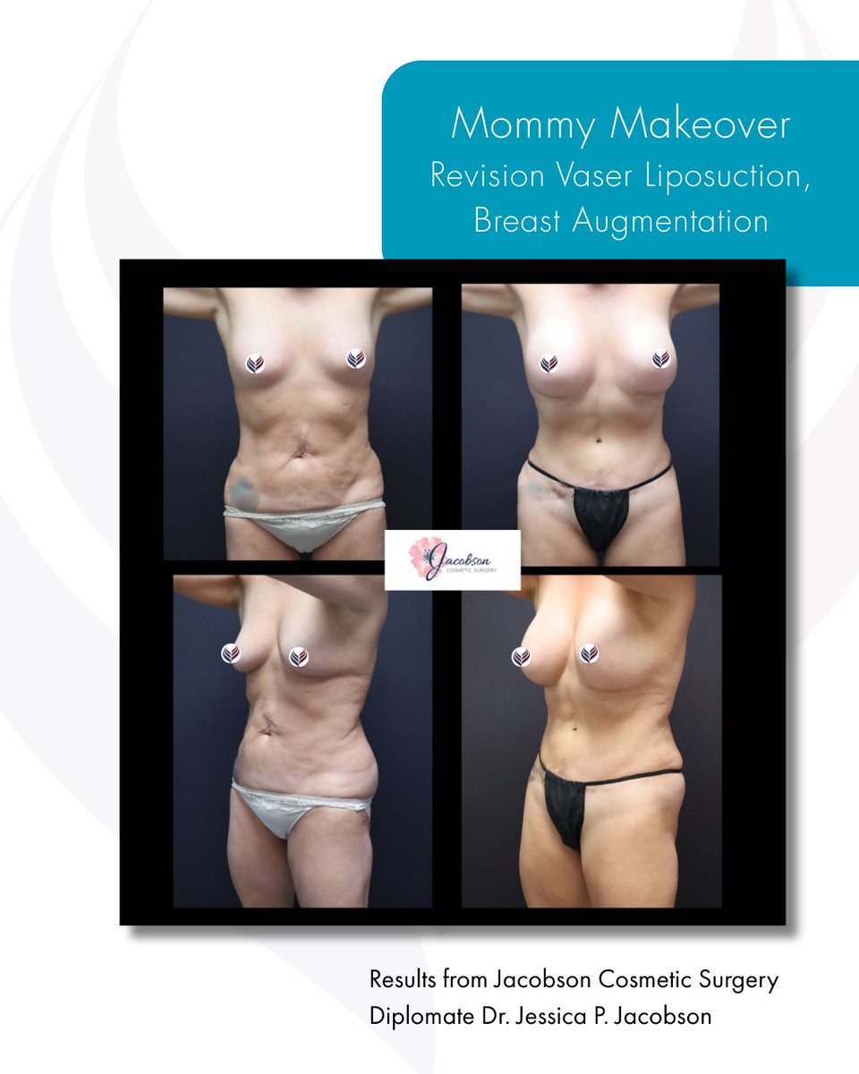 Restored, confident, and feeling like yourself again. 🌟

These mommy makeover results by ABCS diplomate Dr. Jessica P. Jacobson showcase how a customized combination of procedures can help restore your body to its pre-pregnancy state.

#MommyMakeover #CosmeticSurgery