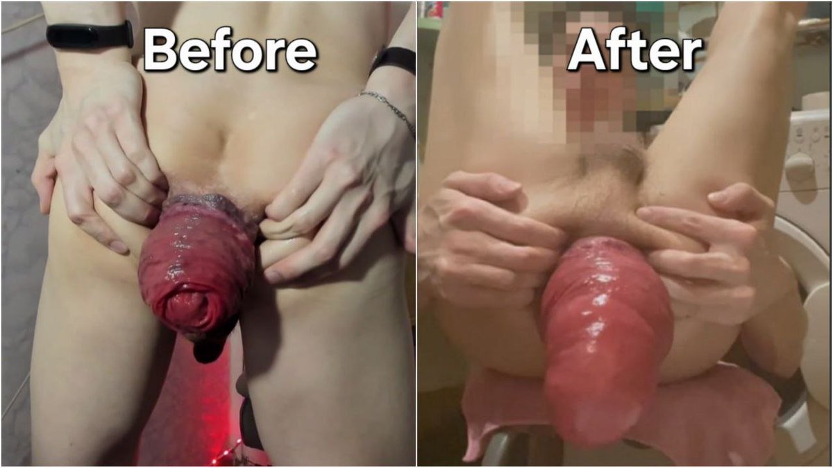 Incredible4388's tweet photo. My result of the development of prolapse BEFORE and AFTER, tired of wasting energy in vain? Do you want a quick result? Then I offer you my own method of developing prolapse! Write to me in a telegram soon! https://t.co/3j7nmtqAT0 https://t.co/9Fm3brKB0a