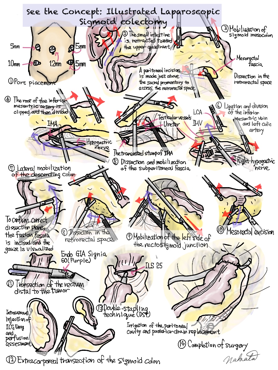 Japan Society for Endoscopic Surgery (JSES) tweet media