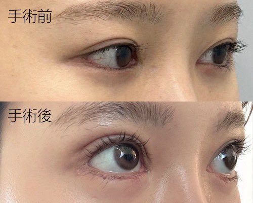 nn__o_o's tweet photo. @olops_jp 
症例が自然で傷跡も綺麗だったオルロ美容外科で逆さまつげ矯正の手術をしました！まだ傷跡が完全には治ってないですがまつ毛がちゃんと下に向いて目の開きも改善された！今までまつ毛が刺さって涙が勝手に出てたのが改善されて嬉しい♡
これからもっと自然になると思うと楽しみ〜〜 https://t.co/jF2eAlthIv