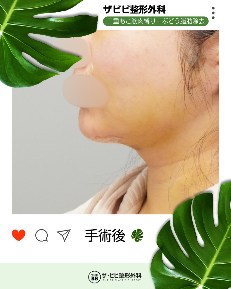 韓国整形🖤ザビビ整形外科 tweet media