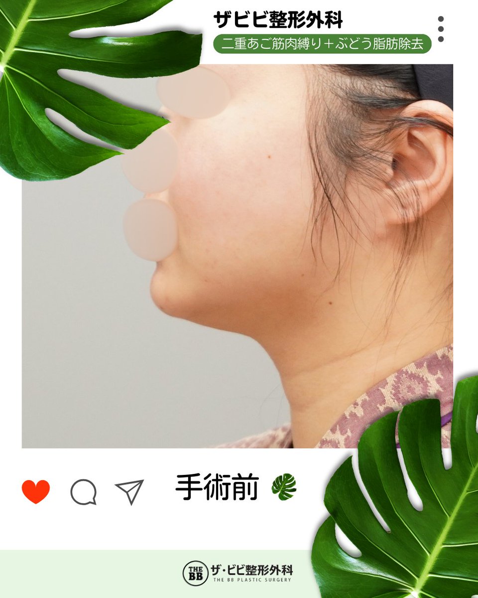 韓国整形🖤ザビビ整形外科 tweet media