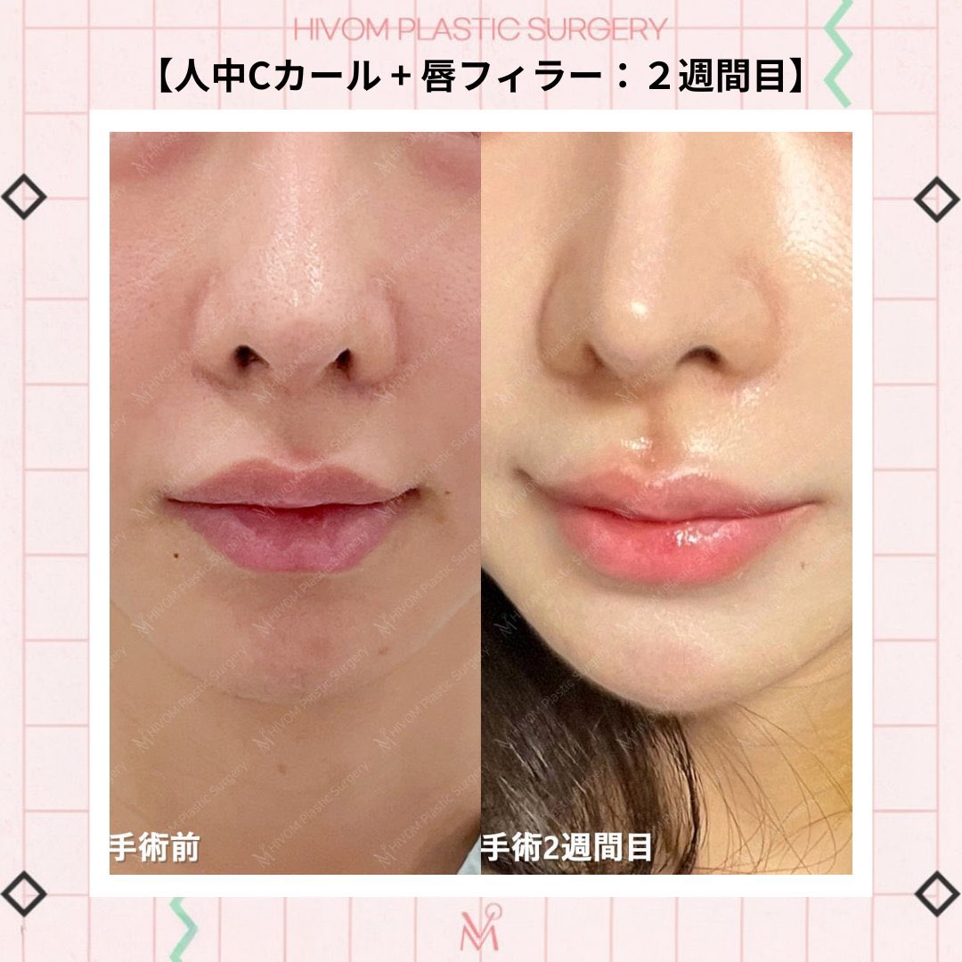 suni__fit's tweet photo. 人中溝形成は絶対やりたい
ワンホンちゃん達もほぼ必須で作ってるよね https://t.co/q97Bz0m7ZQ