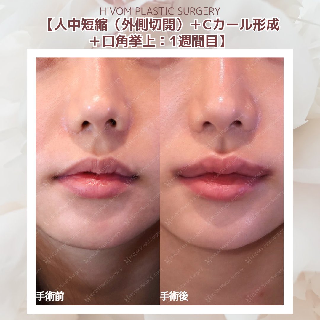 suni__fit's tweet photo. 人中溝形成は絶対やりたい
ワンホンちゃん達もほぼ必須で作ってるよね https://t.co/q97Bz0m7ZQ