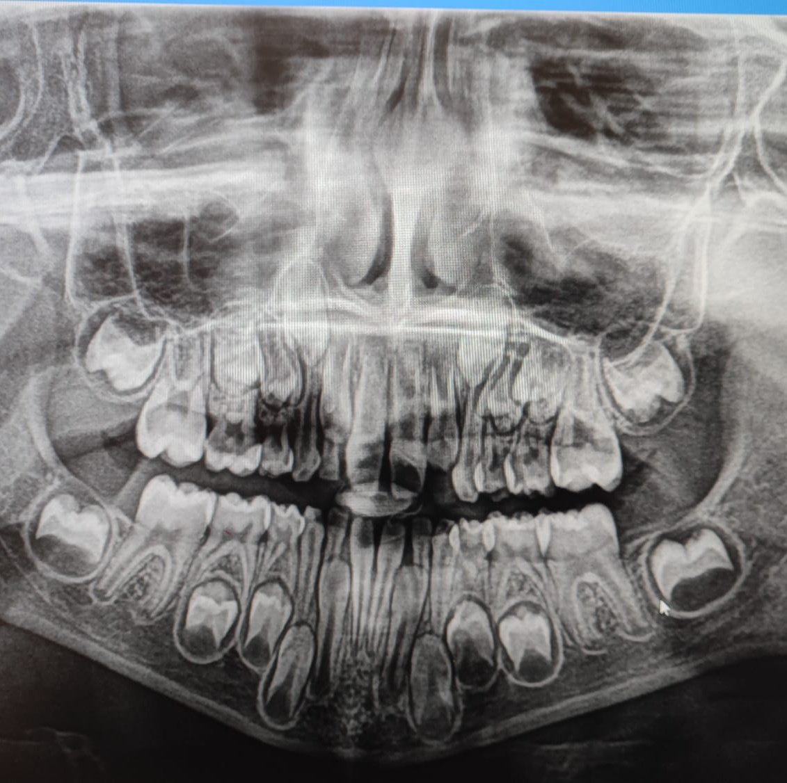 Ayer la troyanita fue al dentista.

Nunca me había planteado como se ve una radiografía de alguien que aún no ha mudado todos sus dientes de leche.😱