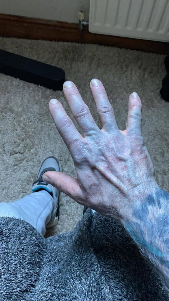 DHKRULLAH's tweet photo. A man was left embarrassed after being rushed to hospital having turned completely blue from head to toe - only to discover the true cause 🙈

Tommy Lynch woke up looking like "an Avatar". His friend took one look at him and rushed him to A&E - worried something might be seriously wrong. 

The 42-year-old was immediately seen by a doctor and given a bed within minutes, while worried staff administered oxygen.

"Everyone in the reception of A&E was gawking at me like they'd seen a ghost," he said. "I had to approach the desk and I didn't even know what to say: 'Hi, I've woken up blue'." 🤷

"The doctors said they'd never seen someone that colour before and still been alive."

When the doctor swabbed his arm with an alcohol wipe, the swab turned blue - and Tommy suddenly realised what had happened 🙈

His friend Del had given him a new £40 bedding set as a gift. But, Tommy didn't realise he had to wash it first.

On the second night of using them, Tommy overslept and woke up in the afternoon completely "bright blue". 

He said: "The day before, I'd shook hands with someone and they looked a light blue then but I thought I was just cold.

"The next night I must have overheated but I was lovely and cosy. My friend, Del, woke me up by knocking on the door as I'd slept for 14 hours and he took one look at me and said I needed to go to hospital."

He added: "As soon as they wiped my arm and it came off blue, it clicked. I was mortified but they said I'd given them a good laugh. They don't usually have funny stories in A&E."

Safe to say, Tommy left the hospital more red in the face than blue...

Copied from Facebook 😀