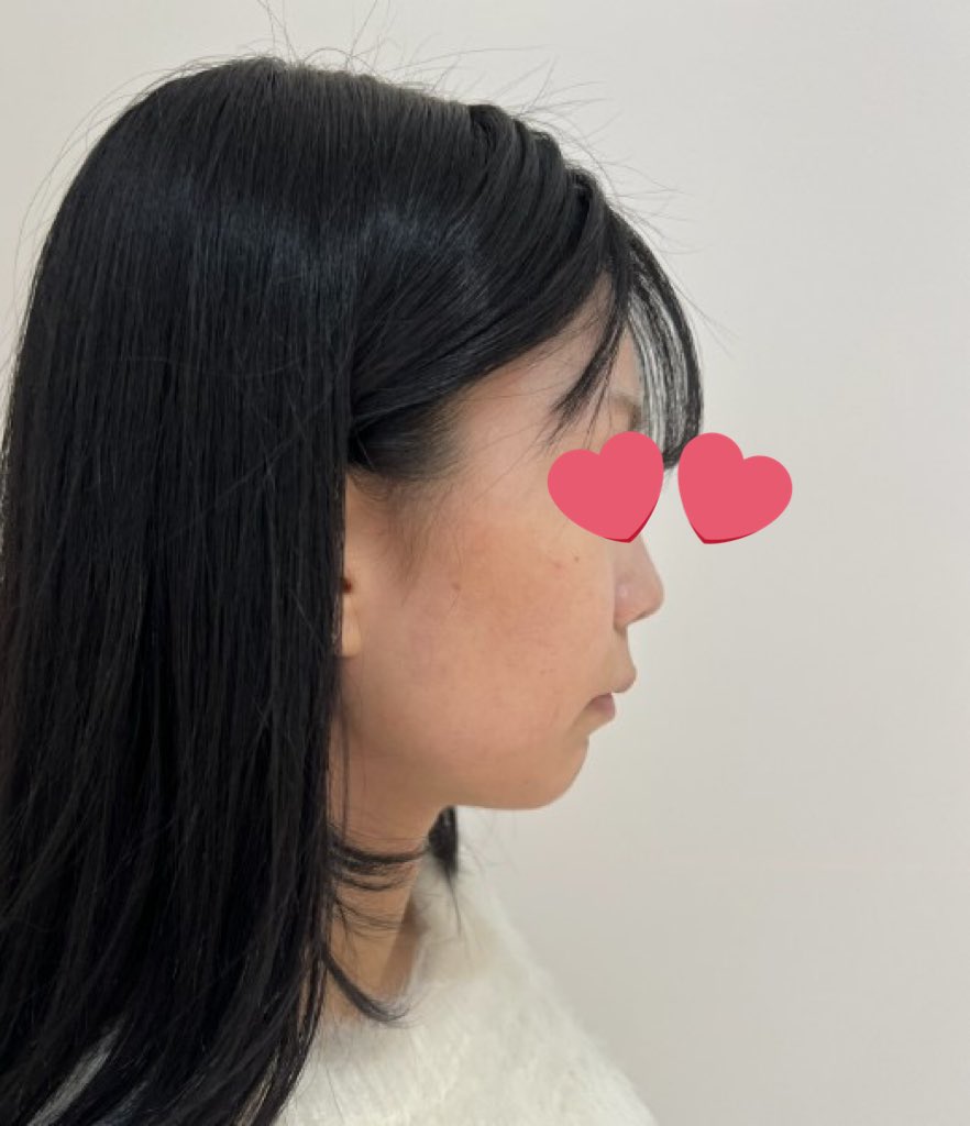 ulu8qk's tweet photo. BIKAN整形外科で鼻フルしてきました！
こんなに大きい美容医療は初めてだったのですごく緊張したけど、スタッフさんもパク先生も優しく寄り添ってくれました🤲
仕上がりも大満足です！！ https://t.co/QyXxtmCPQG