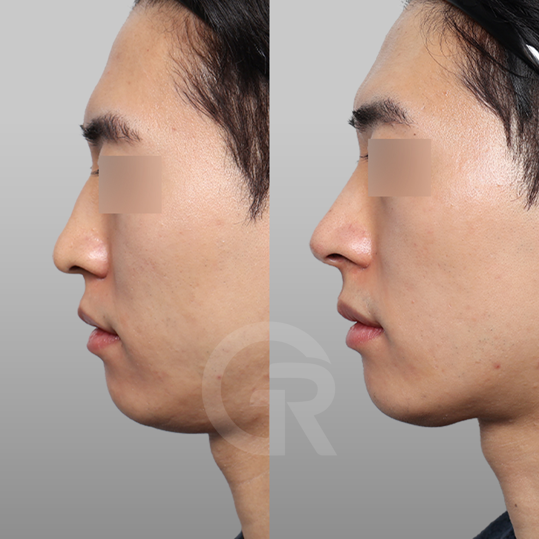 【公式】韓国整形ギリン美容外科 tweet media