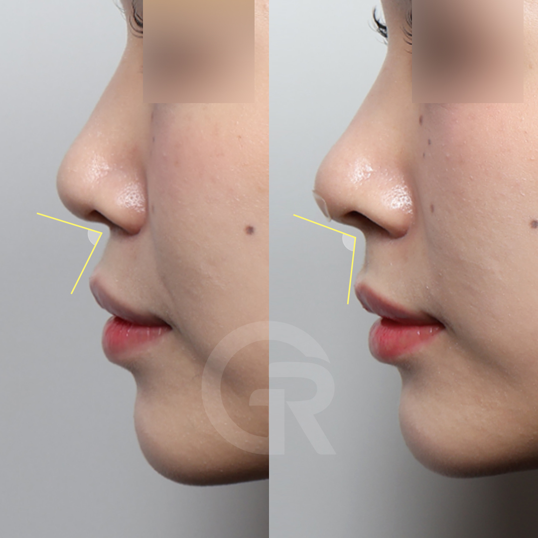 【公式】韓国整形ギリン美容外科 tweet media